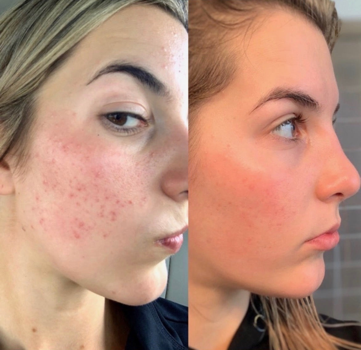 Lactic Acid For Skin