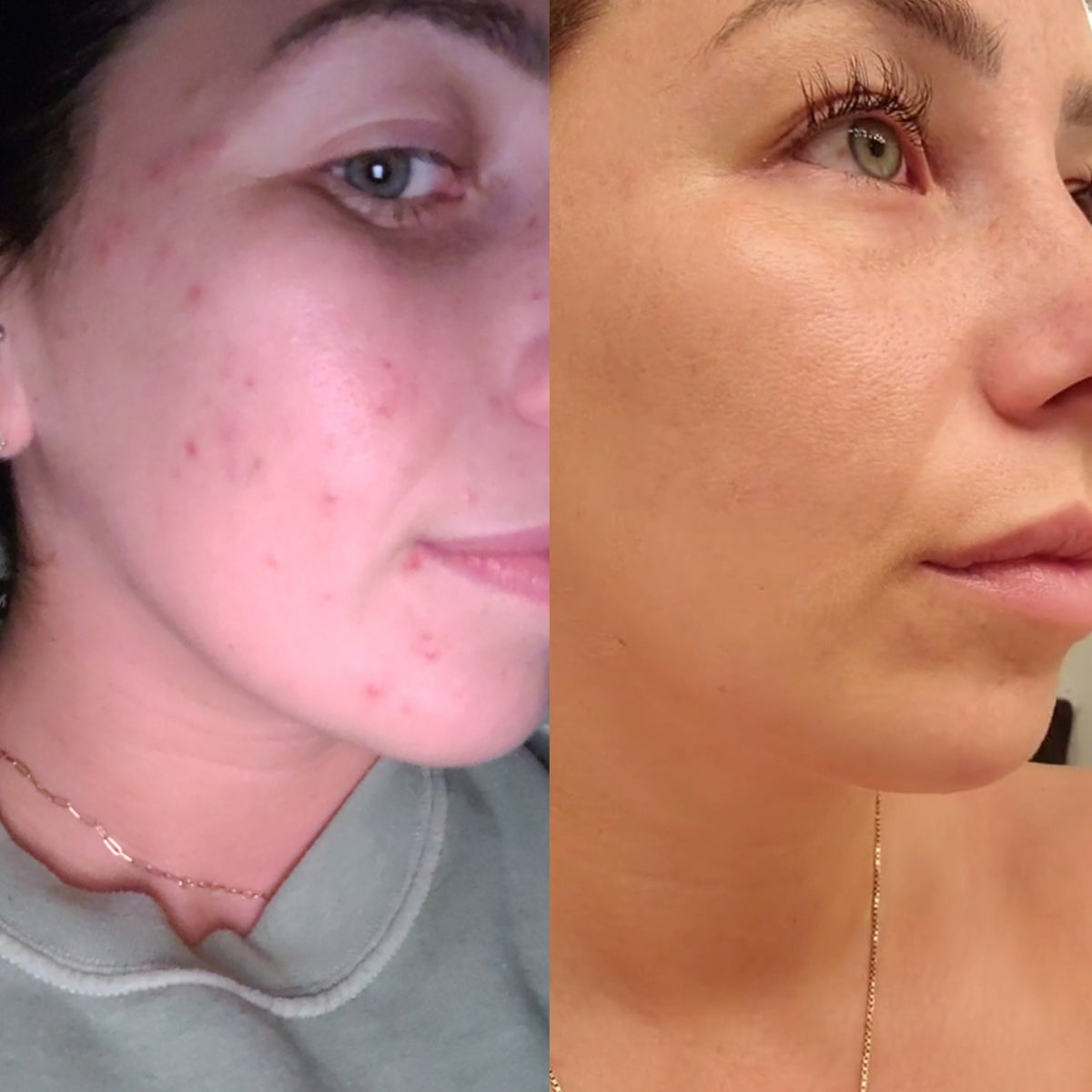 A Nutritionist's journey to healing her skin!