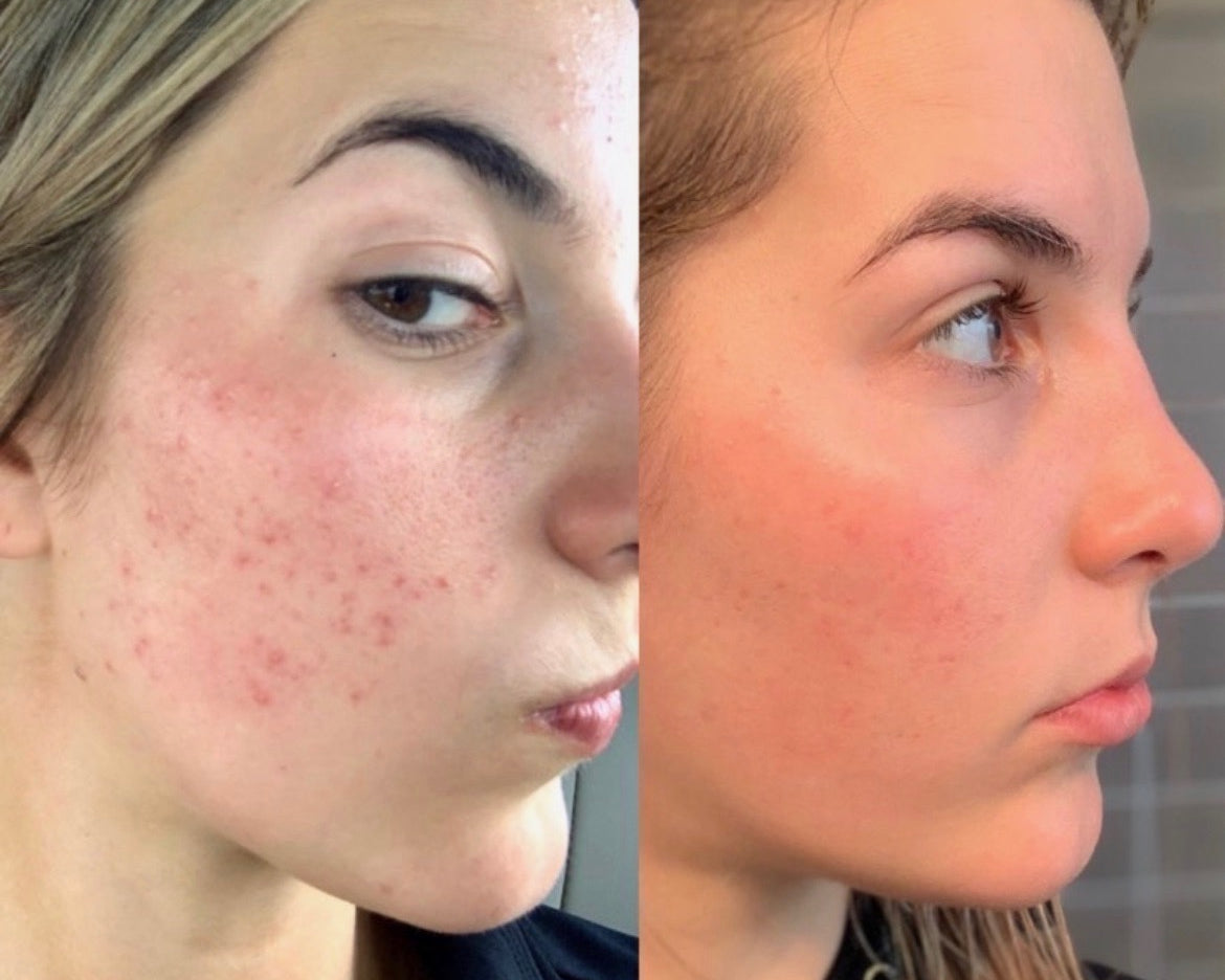 Lactic Acid: A Key to Clear, Glowing Skin