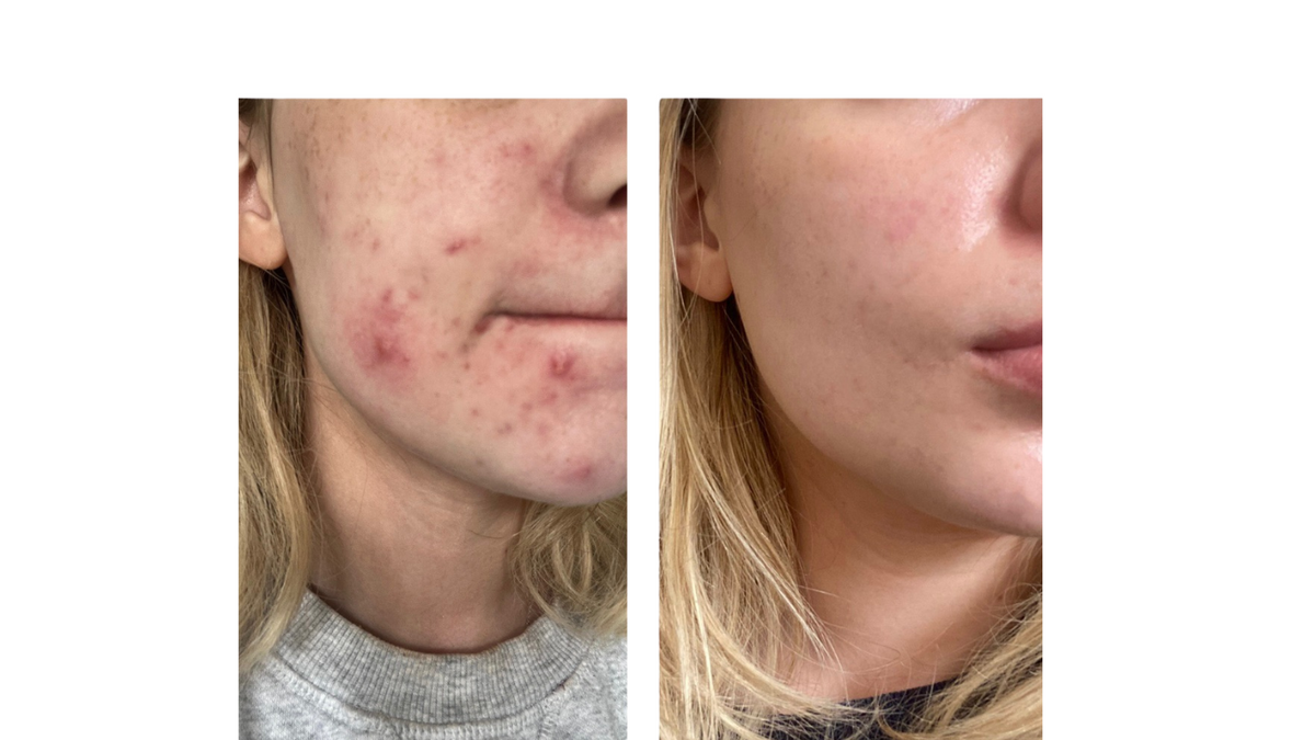before and after acne transformation